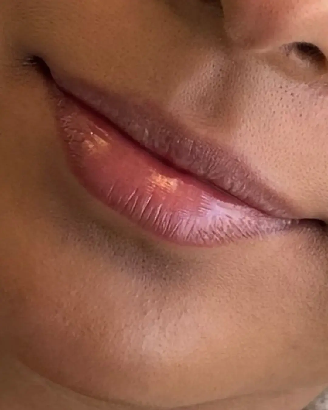 Antes — Aumento de Labios