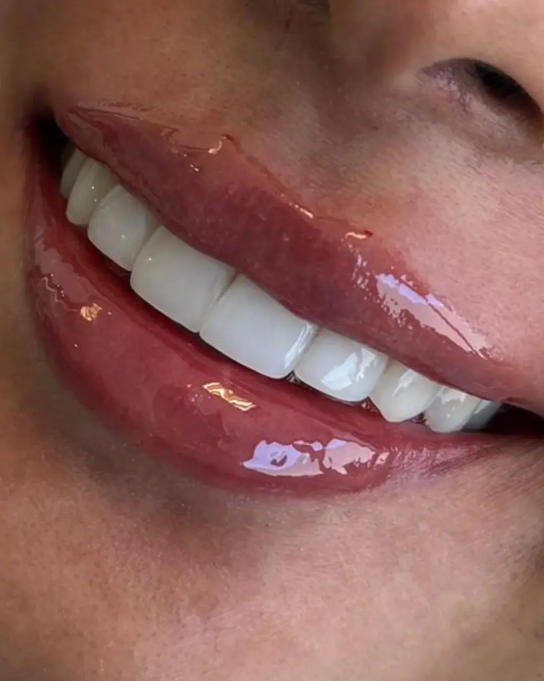 Después — Aumento de Labios
