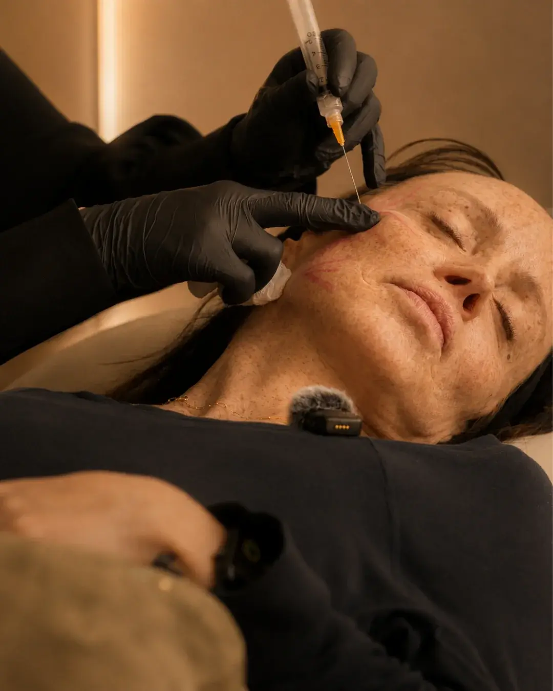 Tratamiento Sculptra® / Bioestimulación en Albanta Aesthetic Spa