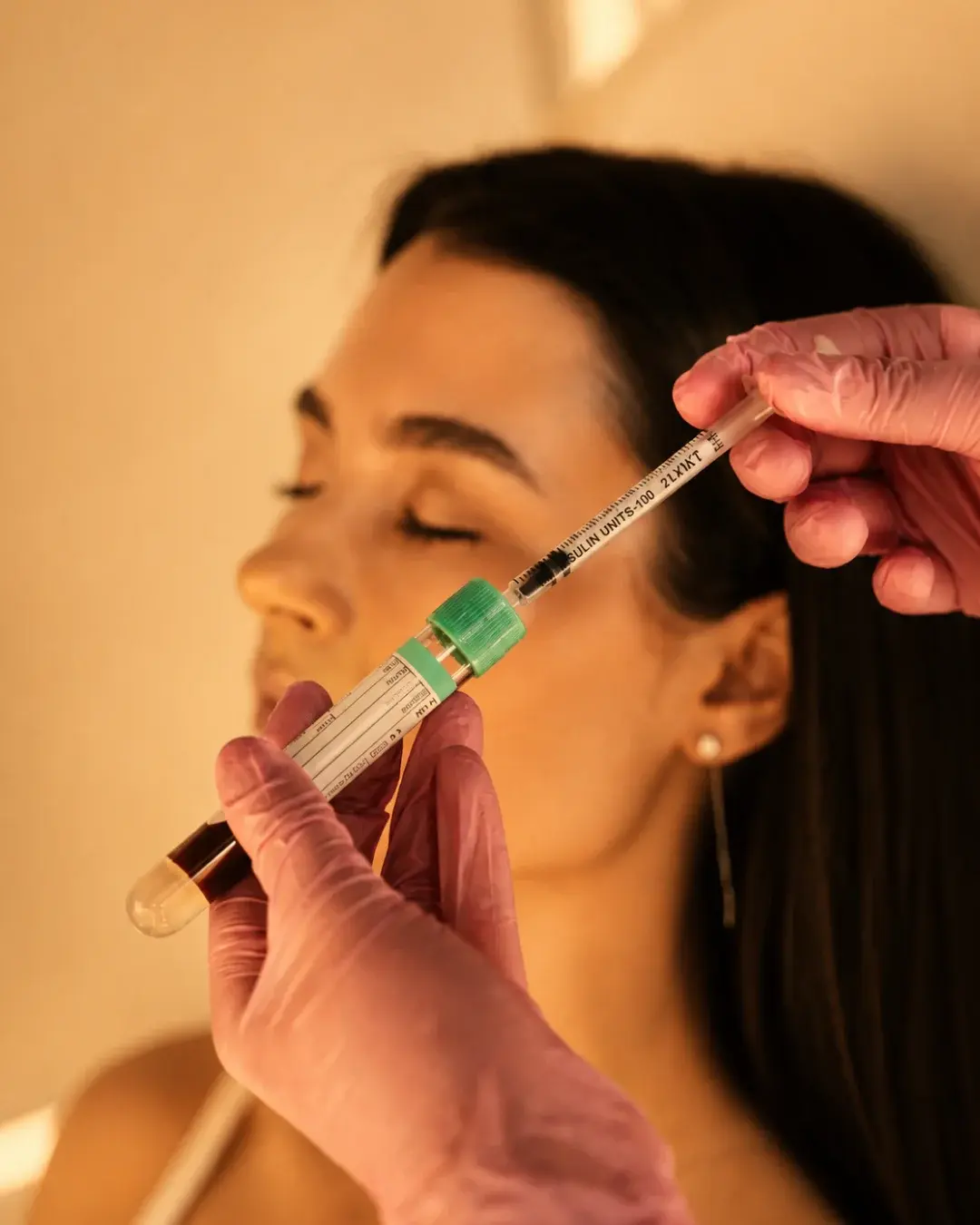Tratamiento Facial Vampiro en Albanta Aesthetic Spa