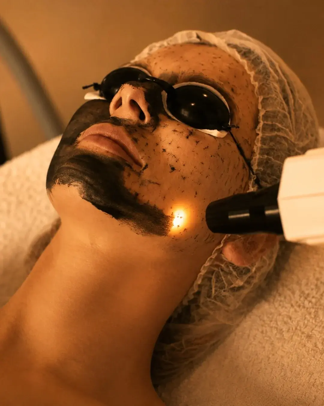 Tratamiento Hollywood Peel en Albanta Aesthetic Spa